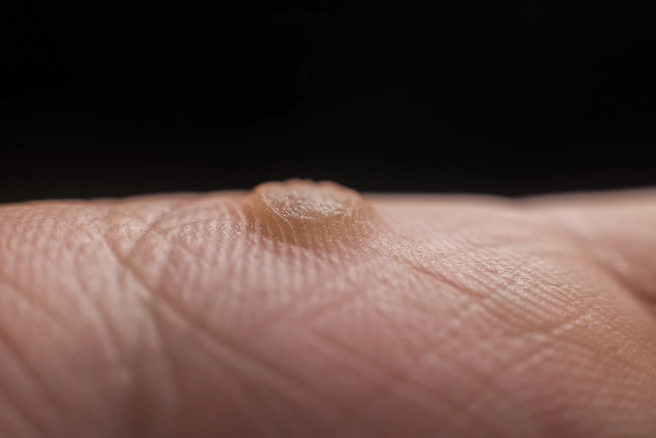 Co na kurzajki i brodawki?