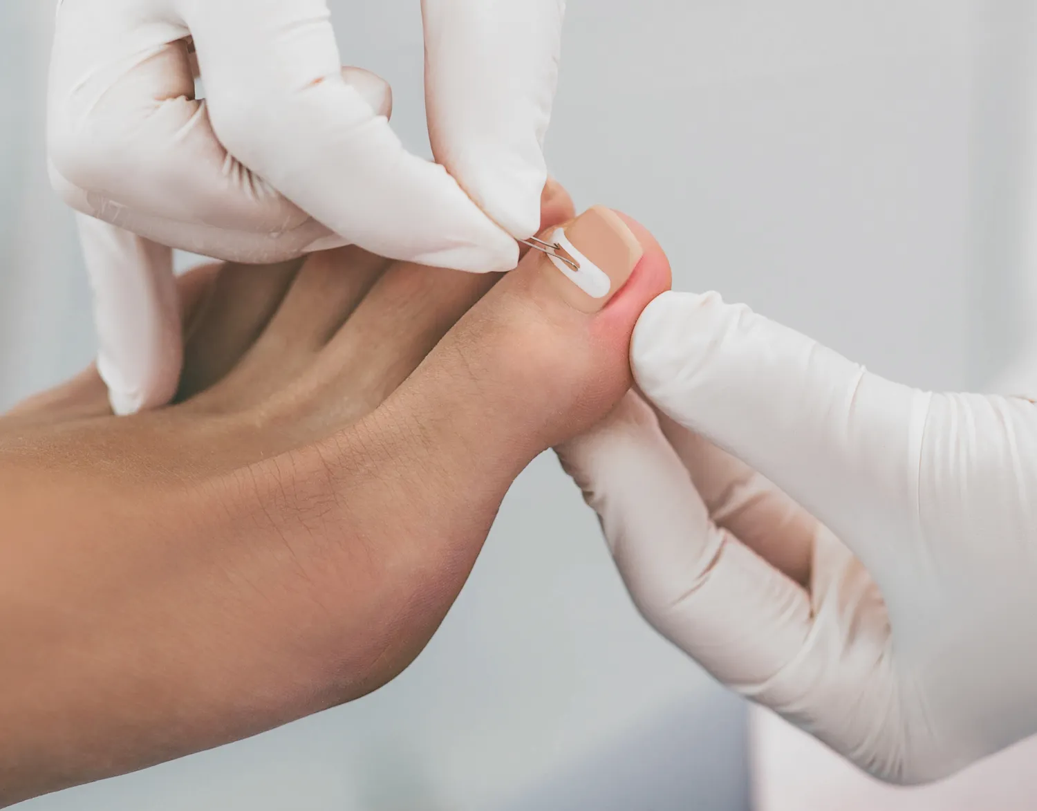  Pedicure leczniczy - co o nim wiedzieć warto?