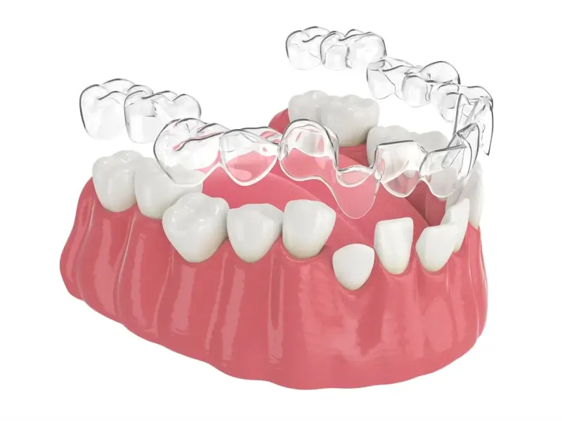 Prostowanie zębów metoda Invisalign